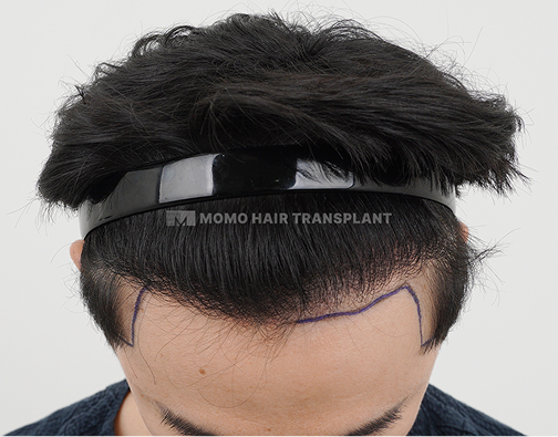 Male FUE hair transplant before