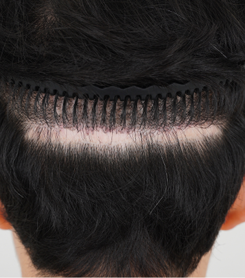 Skin deformation in the occipital area