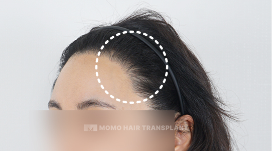 Incorrect graft placement