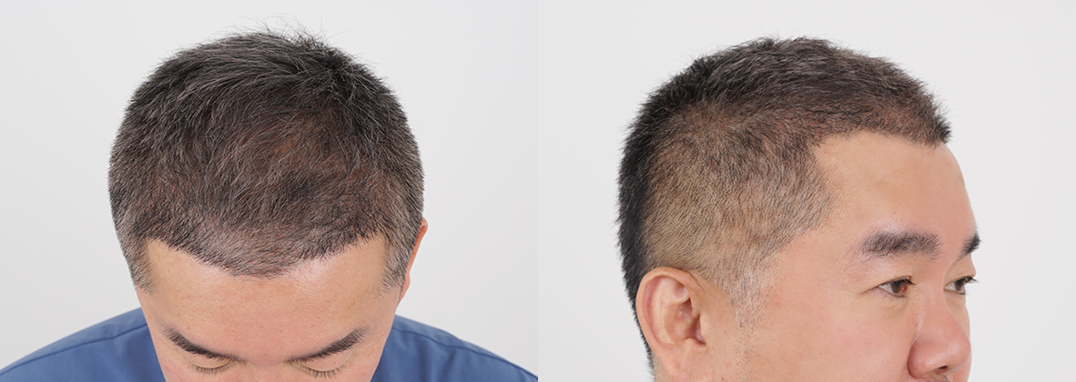 모발이식 after