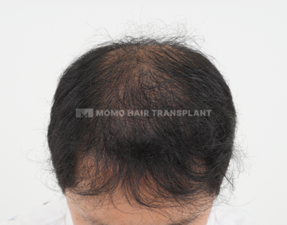 남성 혼용 모발이식 after