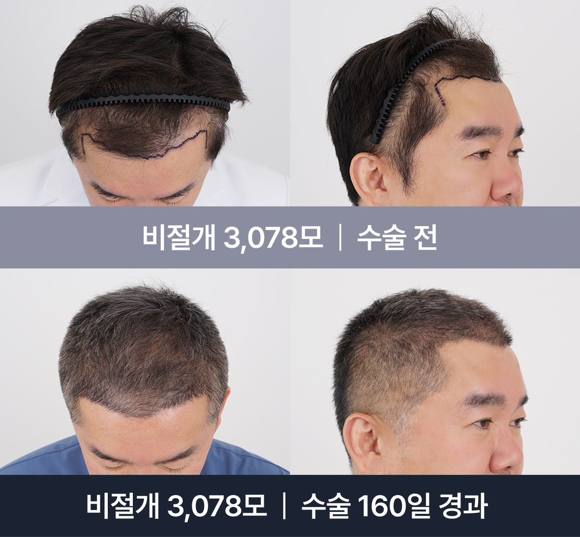 김승준 대표원장 모발이식 스토리