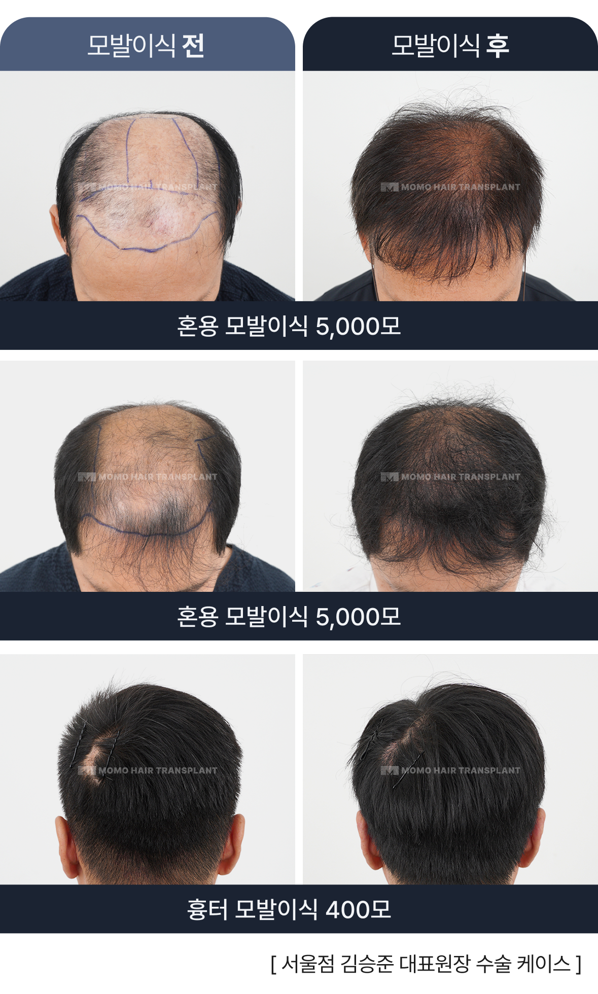 김승준 대표원장 모발이식 스토리