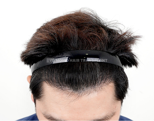 남성 절개 모발이식 after