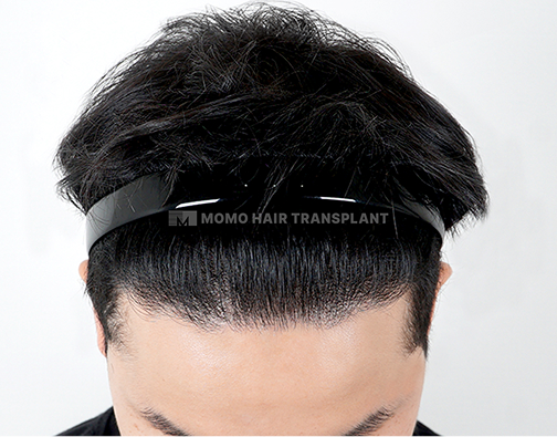 남성 절개 모발이식 after