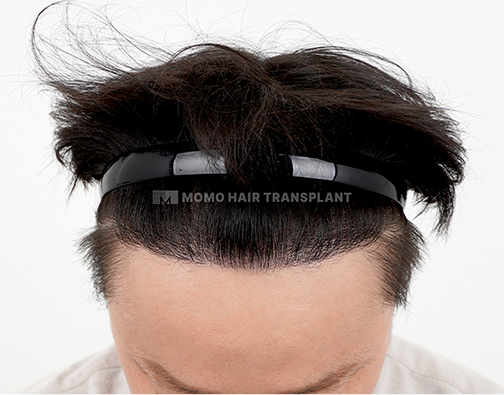 남성 절개 모발이식 after