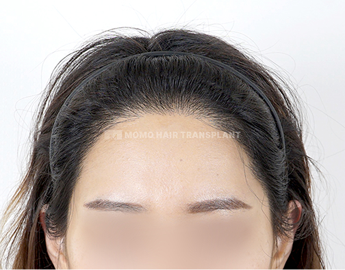 여성 절개 모발이식 after