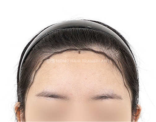 여성 절개 모발이식 before