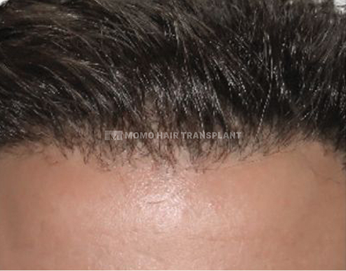 아타스iX 모발이식 after