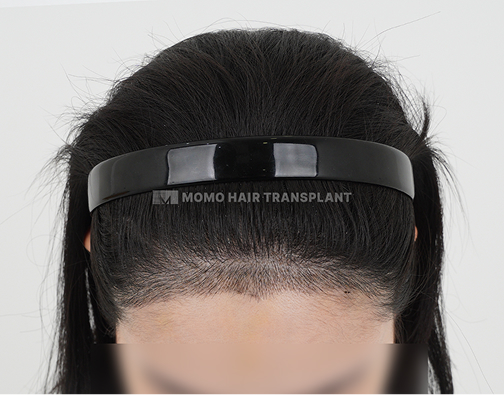 남성 비절개 모발이식 after