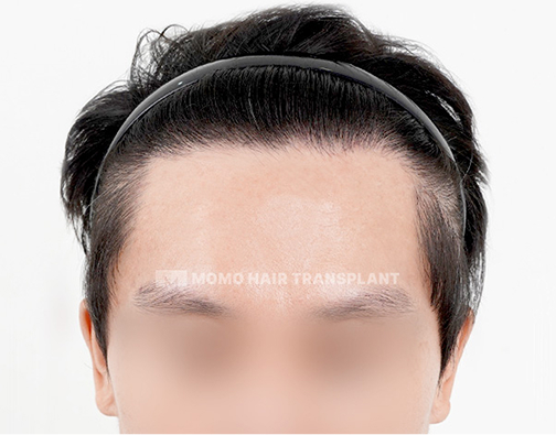 남성 비절개 모발이식 after