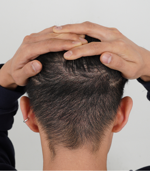 제한적인 수술 가능 횟수