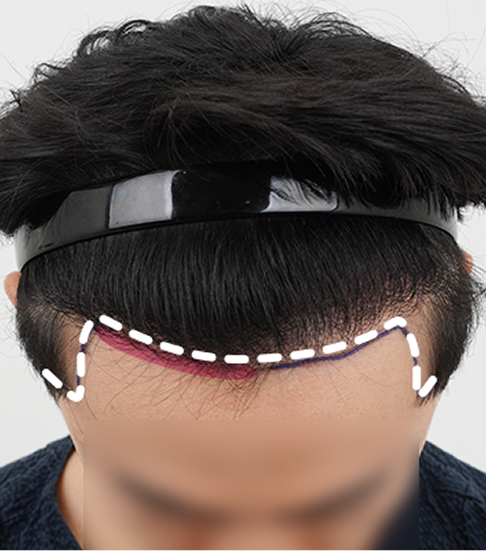 기존 이식 모 제거