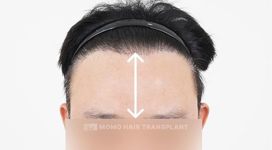 여전히 넓은 이마와 얼굴