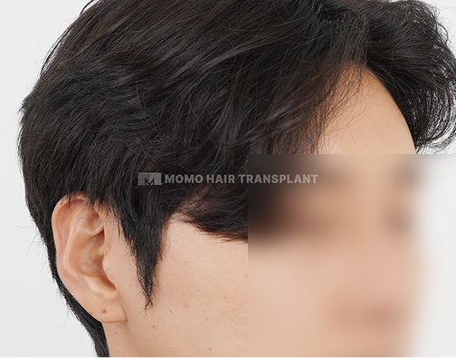 구레나룻 모발이식 after