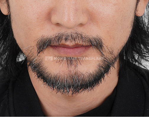 수염 모발이식 after