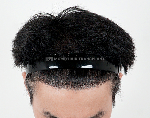 남성 절개 모발이식 after