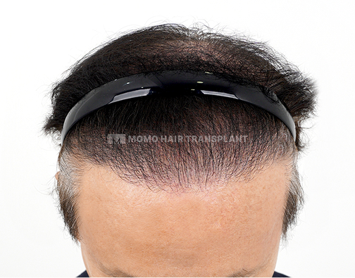 남성 절개 모발이식 after