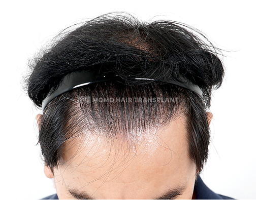 남성 절개 모발이식 after