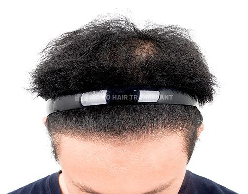 남성 혼용 모발이식 after