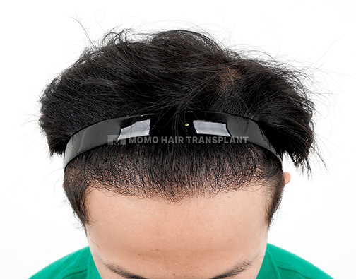 남성 혼용 모발이식 after