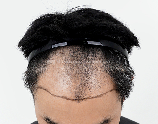 남성 절개 모발이식 before