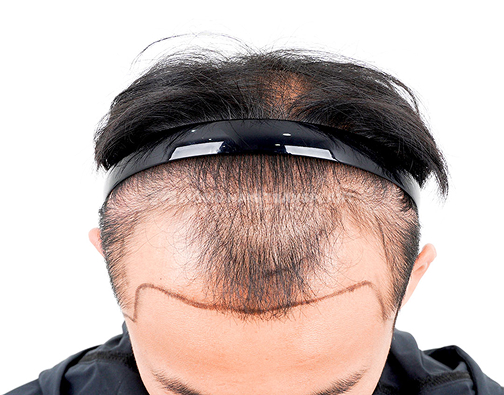 남성 혼용 모발이식 before