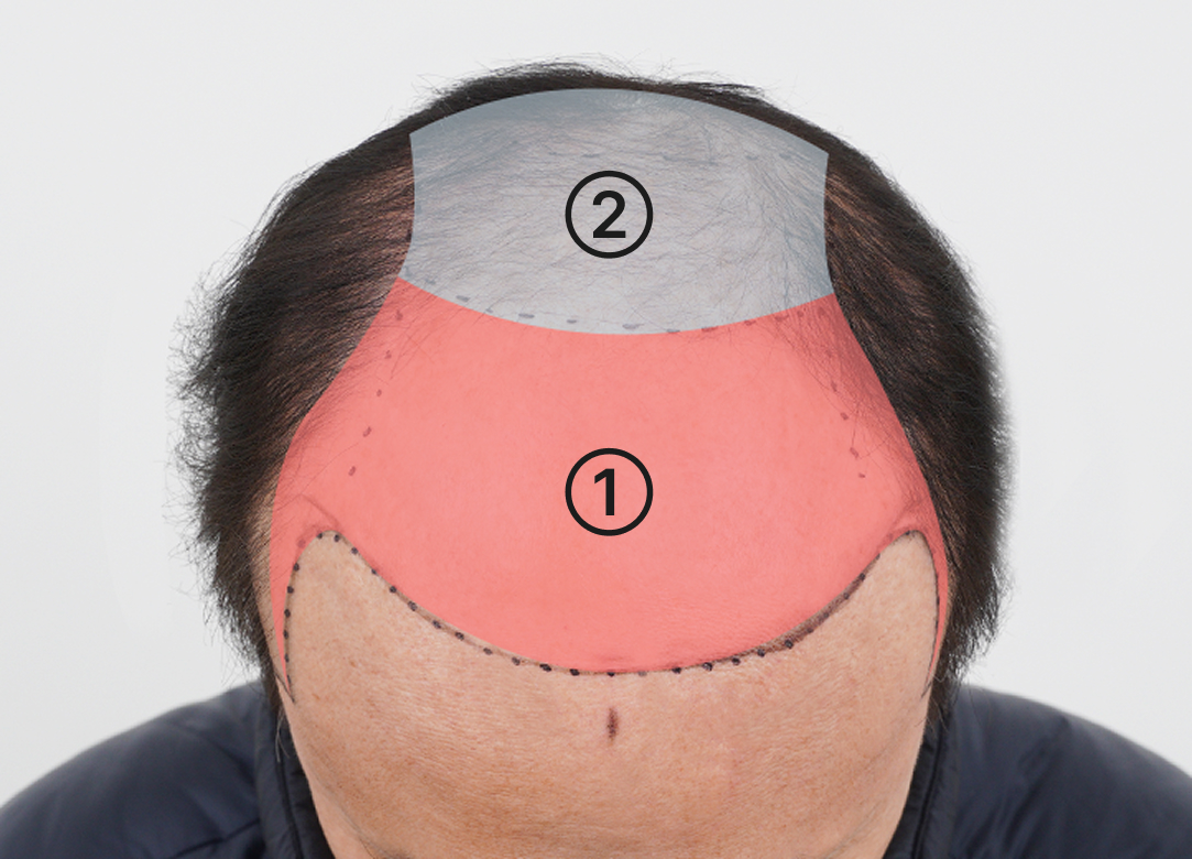 이마 그라데이션 이식