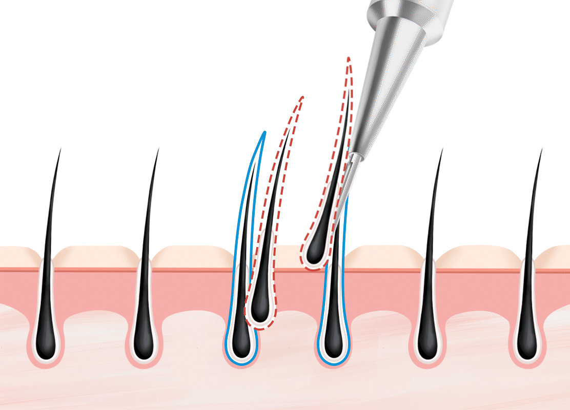 고른 이식 간격으로 생착률 up