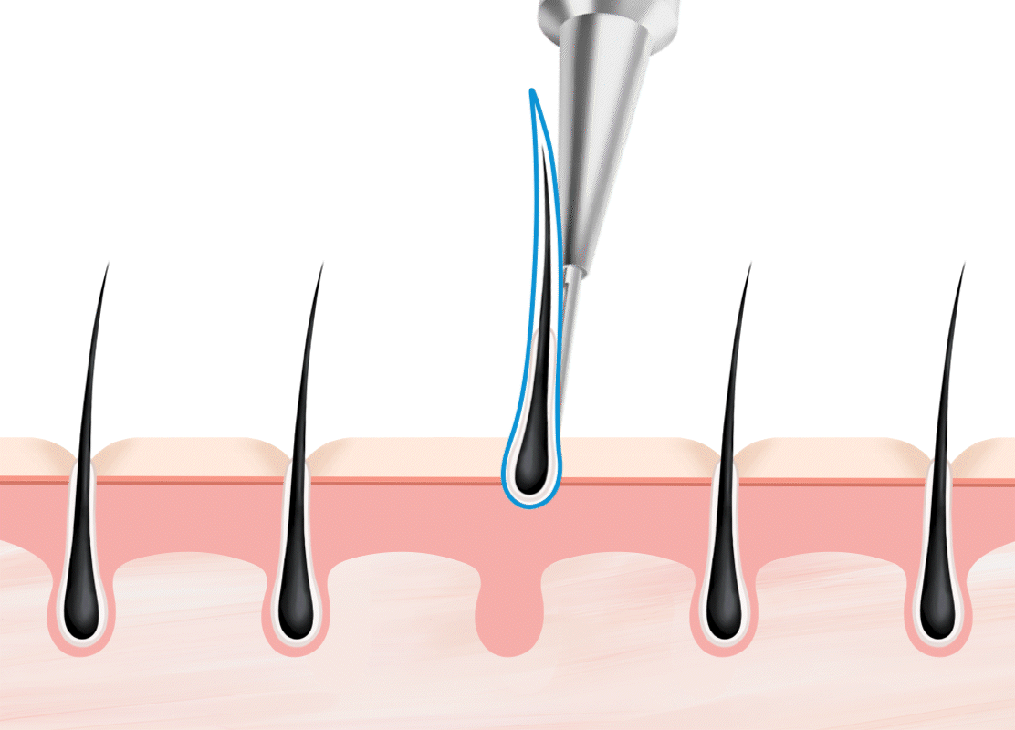 고른 이식 간격으로 생착률 up