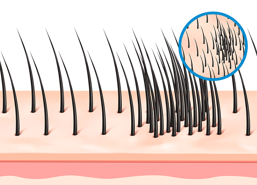 고른 이식 간격으로 생착률 up