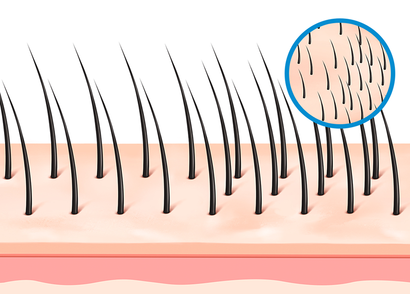 고른 이식 간격으로 생착률 up