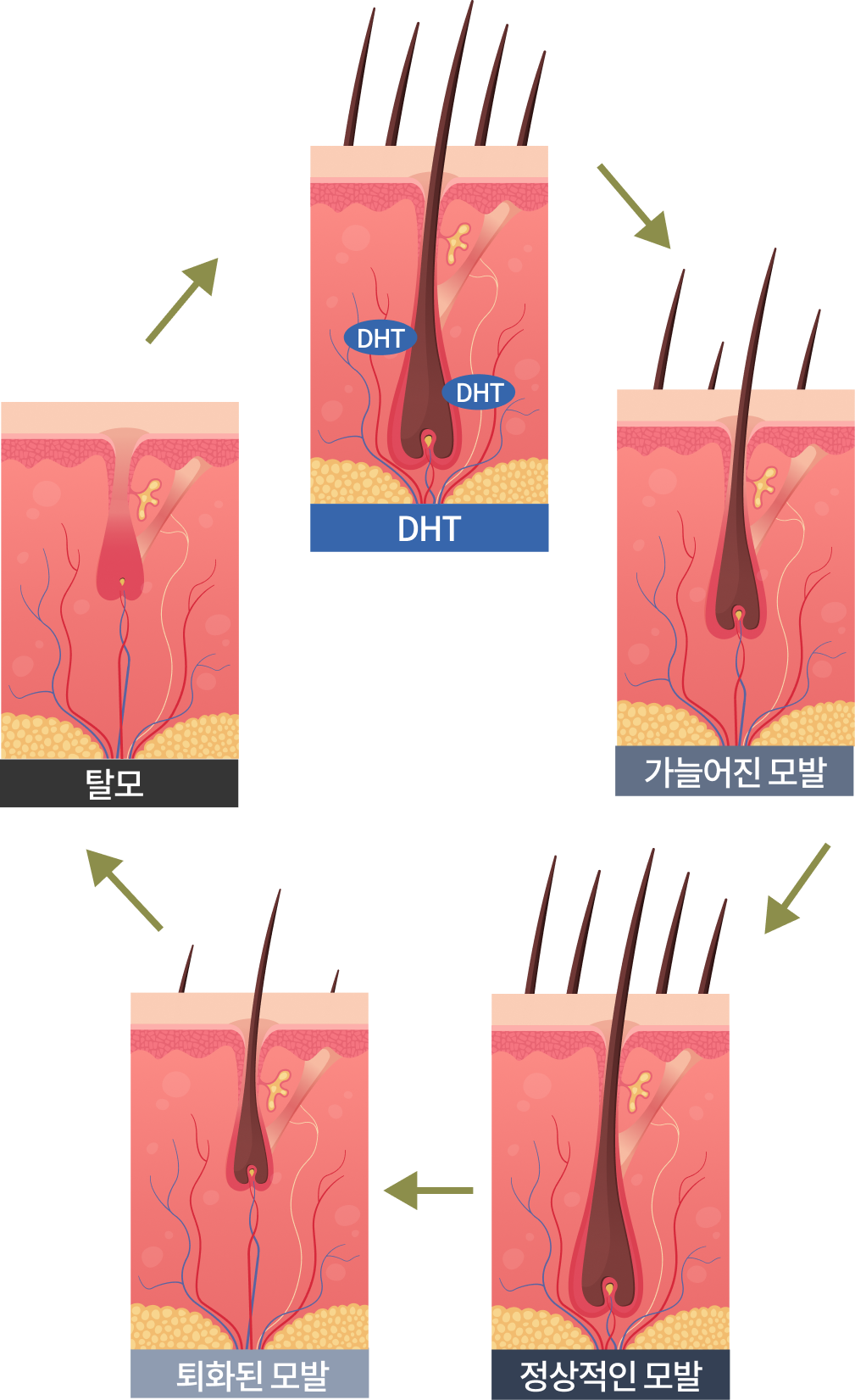 DHT와 유전의 콜라보레이션