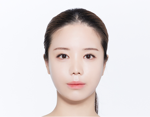 비절개 모발이식 before