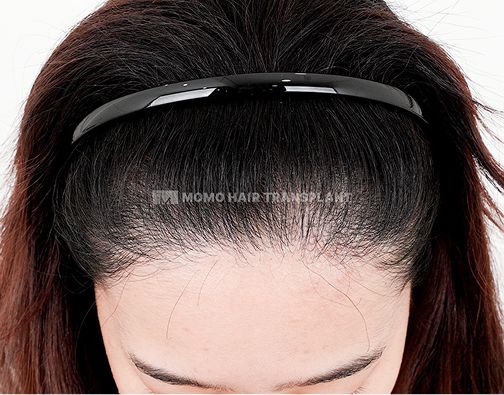 이마거상 흉터커버 비절개 모발이식 after