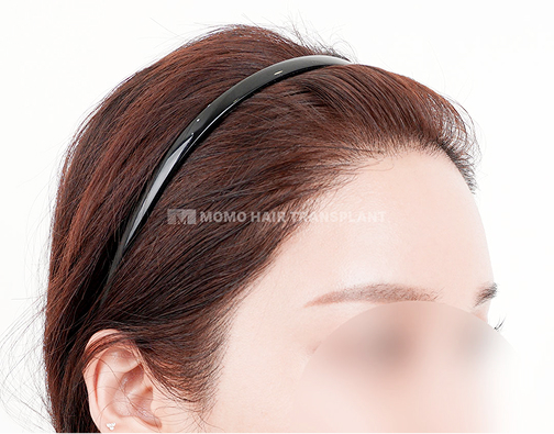 윤곽수술 흉터커버 비절개 모발이식 after