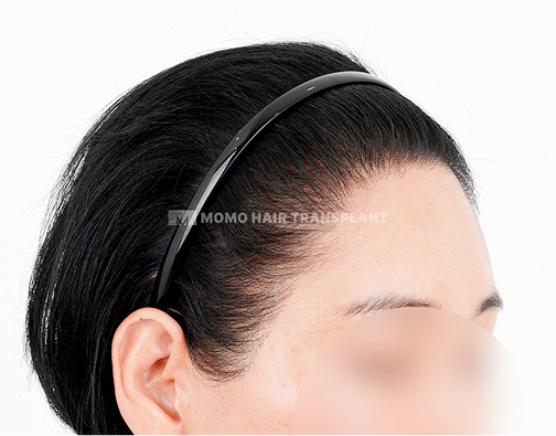 이마거상 흉터커버 절개 모발이식 after