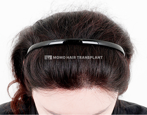 이마거상 흉터커버 비절개 모발이식 after