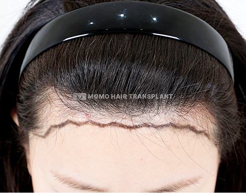 이마축소 흉터커버 절개 모발이식 before