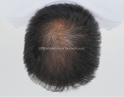 여성 정수리 모발이식 after
