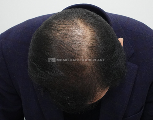 여성 이마거상 흉터커버 비절개 after