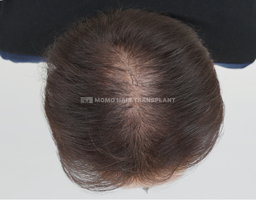 여성 정수리 모발이식 before