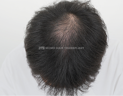 여성 이마거상 흉터커버 절개 before