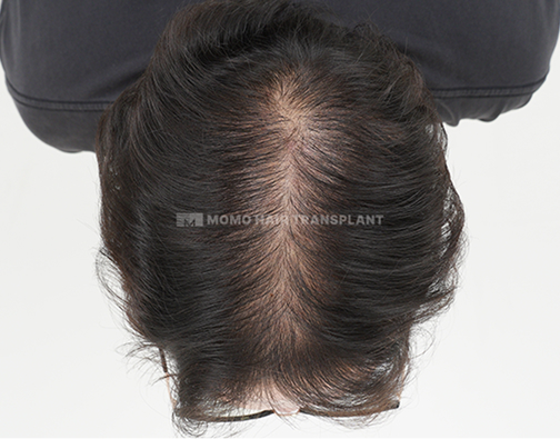 여성 이마거상 흉터커버 비절개 before