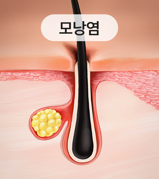모낭염